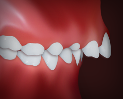  Protrusion of Upper Teeth