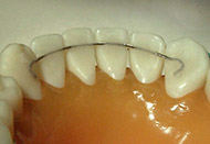 Bonded Permanent Retainer 